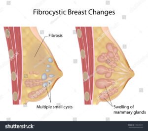 Read more about the article FIBROCYSTIC BREAST CHANGES: How to manage them.