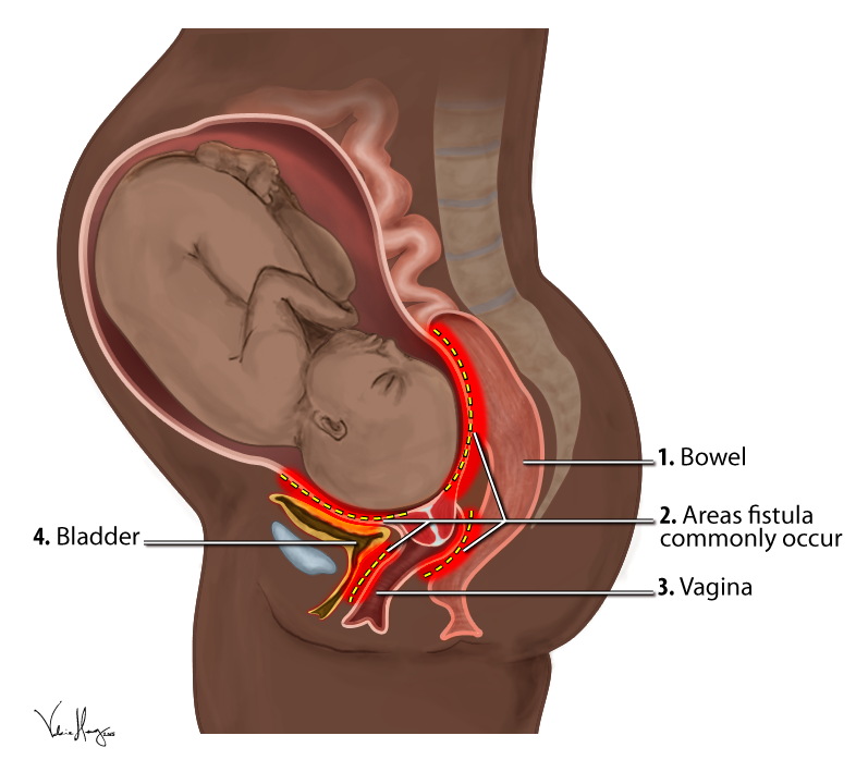 You are currently viewing Understanding Obstetric Fistula using the Haddon Matrix: We can prevent this catastrophe.