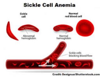 You are currently viewing People with Sickle Cell Disease should timely drink water. Why?