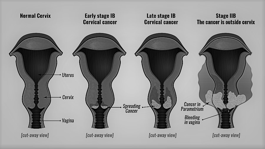 You are currently viewing Cervical cancer: Revised FIGO staging.