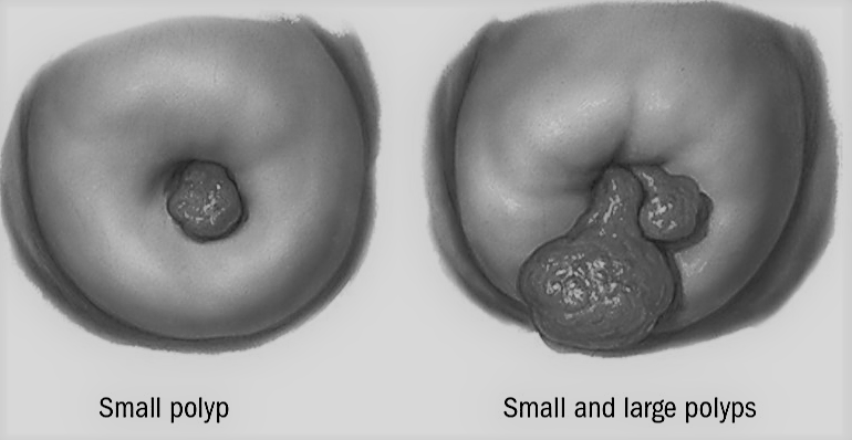 You are currently viewing Cervical Polyps: What you should know.