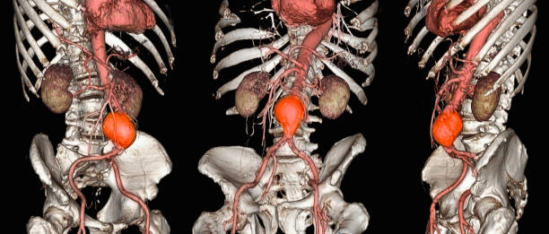 Read more about the article Abdominal aortic aneurysm: controlling blood pressure will save you from the catastrophe.