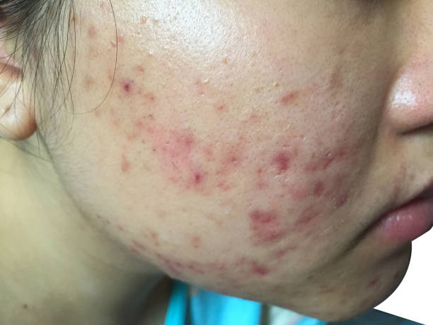 Read more about the article Acne: How to manage your pimples?
