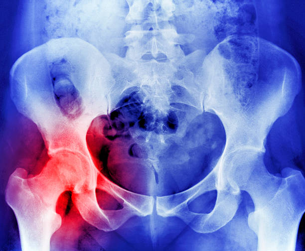 Read more about the article Osteoporosis. When you don’t nourish your bones, they break.