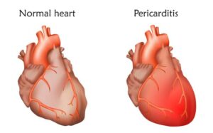 Read more about the article Pericarditis. Diagnosis is challenging: recovery takes weeks!