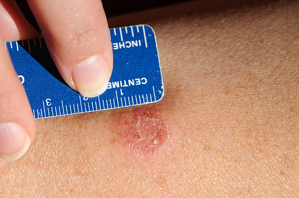 Read more about the article Ringworm. You might have treated it wrongly.