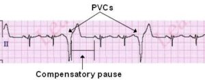 Premature Ventricular Contractions (PVCs). Palpitations should bother you, but to what extent.