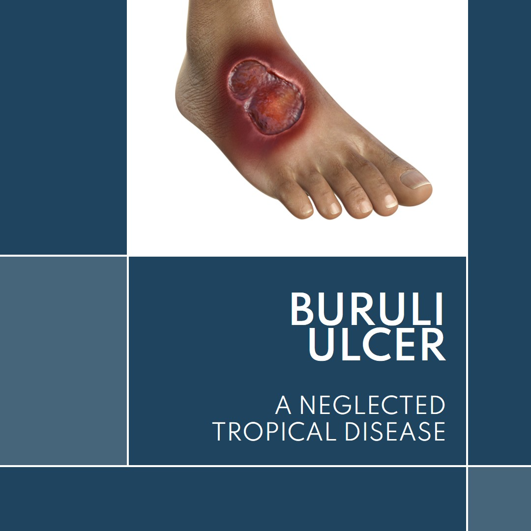 Read more about the article Unveiling Buruli Ulcer: Understanding a Neglected Tropical Disease